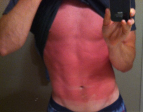 sunscreen allergic reaction #11